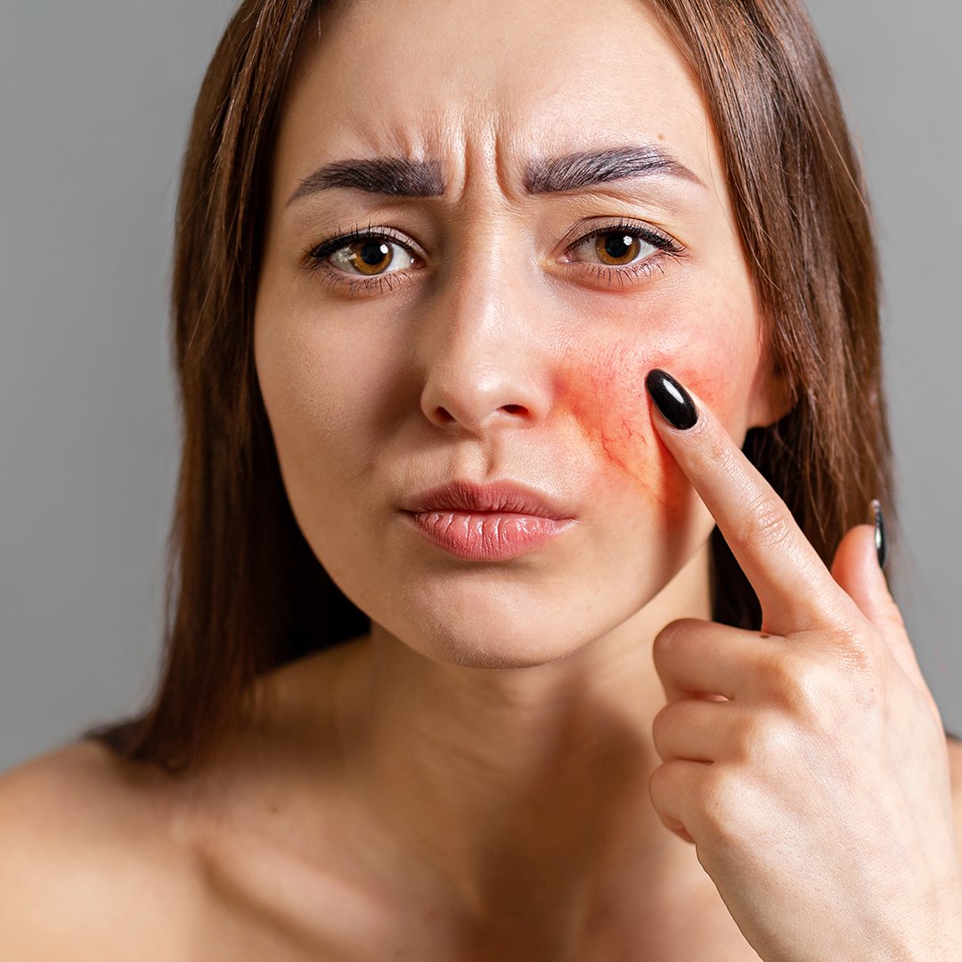 A woman with inflammation on her cheek